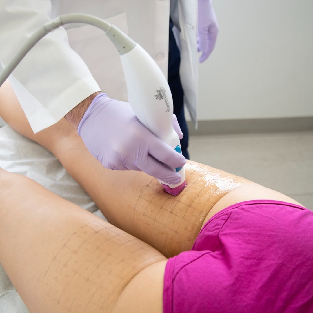 Thermage® FLX