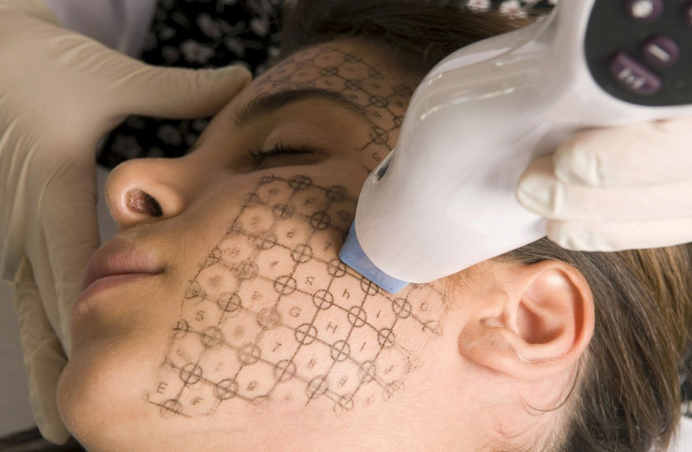 Thermage® FLX